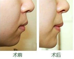 南寧整形豐胸醫(yī)院排名及評(píng)價(jià)互動(dòng)：哪家醫(yī)院效果更好？