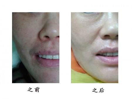 2023山西納米微針祛妊娠紋前10醫(yī)生口碑榜(王玉明、王姝、薛志峰實(shí)力口碑一一盤(pán)點(diǎn))