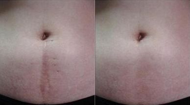 【大連市激光袪疤治療排名】哪家醫(yī)院激光袪疤好？