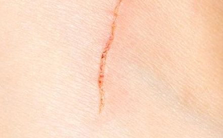 深圳去眼袋醫(yī)院哪家技術先進，效果好