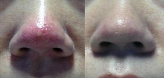 2023年浙江地區(qū)雙眼皮手術(shù)哪家醫(yī)院好，專屬權(quán)威排行榜