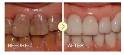 西安畫美楊萬忠鼻部整形效果解析！楊萬忠醫(yī)生簡介及收費(fèi)準(zhǔn)則！