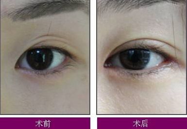 煙臺整疤痕哪家醫(yī)院好？了解煙臺整疤痕醫(yī)院的綜合評價(jià)和治療效果