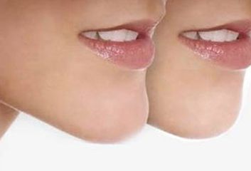 河南唇腭裂休復(fù)哪家好？專業(yè)醫(yī)院推薦及成功案例分享