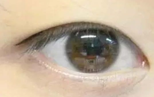 揭曉2023年武漢哪家醫(yī)院割雙眼皮好，專家推薦及真實案例！