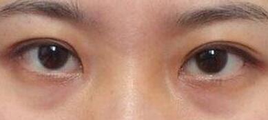 何照華下頜角手術(shù)的效果如何？明星們做了手術(shù)前后對比驚艷！