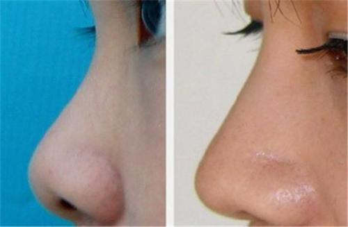 2023鄭州微雕祛除妊娠紋正規(guī)醫(yī)生排名榜十強(qiáng)(周蓓清、張楠、許民安誠摯推薦給您)