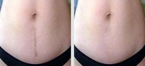 聊城激光祛痘醫(yī)院哪家好？選擇聊城最適合你的激光祛痘醫(yī)院