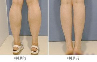 全國激光點痣哪家醫(yī)院好？帶你全面了解最佳選擇！