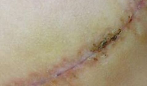 太原疤痕醫(yī)院排名哪家好？解密太原疤痕治療領(lǐng)域中的第一名