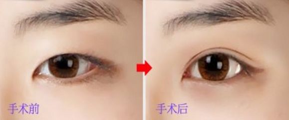 上海玻尿酸豐唇哪家醫(yī)院好？挑選上海口碑好的玻尿酸豐唇醫(yī)院