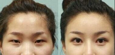 深圳隆鼻手術(shù)效果如何？哪家醫(yī)院的鼻綜合技術(shù)較好？