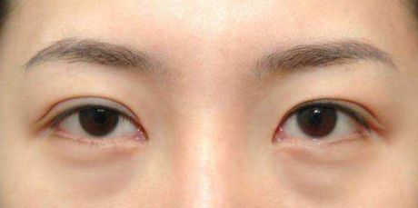 昆明做雙眼皮手術好的醫(yī)院有哪些？