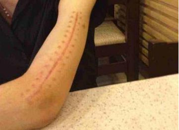 哈爾濱疤痕醫(yī)院哪家好？2023最新排名及患者口碑綜合分析