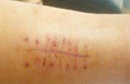 重慶治療雀斑靠譜的醫(yī)院有哪些？