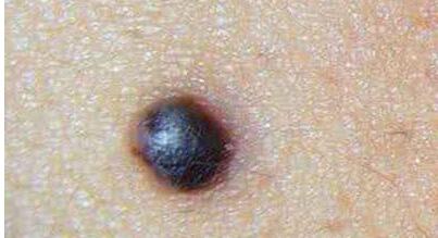 上海沈鶯鶯最新雙眼皮效果揭秘，價(jià)格公開！驚艷案例分享