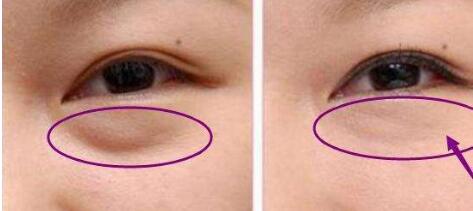 東莞豐胸醫(yī)生名單推薦！權(quán)威醫(yī)師梁如光、鄭志敏等值得信賴