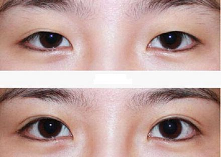 【2023年蘭州歪脖子手術(shù)哪家好？專家推薦+真實(shí)案例分析】