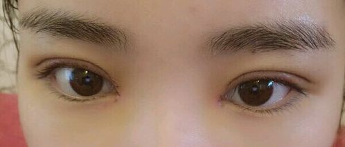 福州哪里可以去除胎記？福州去胎記醫(yī)院排名哪家好？