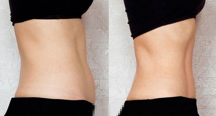 朝陽市哪家醫(yī)院做雙眼皮效果好？