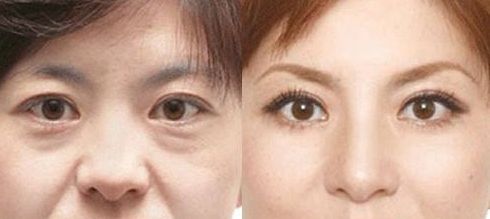 成都做乳暈漂紅哪家好？乳暈漂紅的價格、效果、方法哪種最合適？