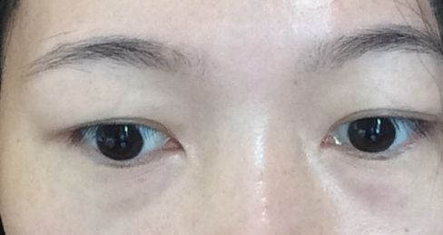 杭州祛雀斑哪家醫(yī)院好？選擇最適合您需求的專業(yè)祛雀斑醫(yī)院