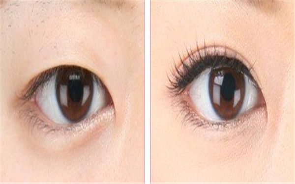 徐州雙眼皮手術(shù)哪家醫(yī)院好？推薦經(jīng)驗(yàn)豐富的專業(yè)醫(yī)療機(jī)構(gòu)！