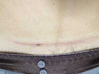 2023內(nèi)蒙古吸脂瘦身腹權(quán)威專家上榜前幾(李曉梅、劉露、韓楓技術(shù)、審美、口碑通通有)