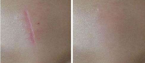 深圳哪家醫(yī)院脂肪豐胸效果好？