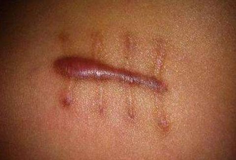 西安熱瑪吉醫(yī)院哪家好？揭曉西安市優(yōu)秀的熱瑪吉治療機(jī)構(gòu)