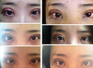 長沙哪家醫(yī)院的拉皮手術(shù)最好？專家推薦的拉皮手術(shù)醫(yī)院有哪些？