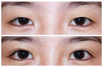 2023安徽韓式三點(diǎn)雙眼皮權(quán)威專家排名前十(劉愛國(guó)、王凱、朱飛口碑評(píng)價(jià)都很高)