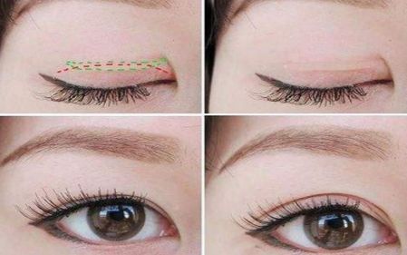 上海打臥蠶哪家醫(yī)院好？選擇上海治療臥蠶一流的醫(yī)院