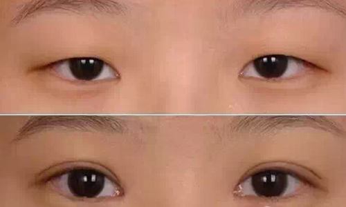 2023廣東肉毒素打細紋正規(guī)專家前十位(梁偉中、惠俐、匡斌概況、技術(shù)、口碑分析)