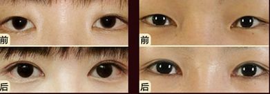 嘟嘟唇無錫哪家醫(yī)院好？專家推薦無錫哪家醫(yī)院治療嘟嘟唇好