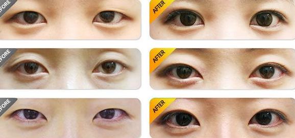 北京做雙眼皮哪家醫(yī)院好？排名最靠前的北京雙眼皮醫(yī)院有哪些？