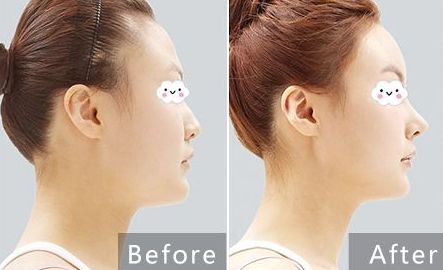 貴陽治療痘坑哪家醫(yī)院專業(yè)可靠？