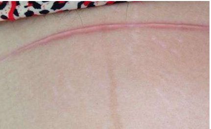 福州哪家醫(yī)院打玻尿酸效果好？