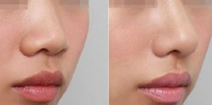 深圳修復(fù)雙眼皮哪家醫(yī)院好？淺談深圳雙眼皮修復(fù)專家排行榜