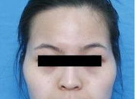 成都治療臉上痘痘哪家醫(yī)院好？專(zhuān)家推薦的成都治痘好醫(yī)院大揭秘！