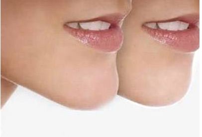 嘉興割雙皮哪家醫(yī)院好？為您推薦嘉興市內(nèi)專業(yè)割雙皮醫(yī)院排行榜