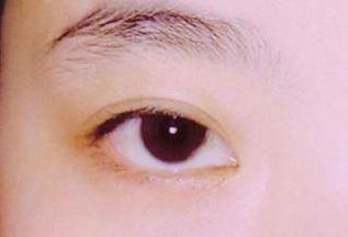 西安看胎記醫(yī)院哪家好？選擇胎記?？漆t(yī)院，專業(yè)技術(shù)得到用戶好評！