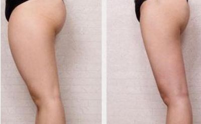 商丘做雙眼皮去哪家好？選擇最適合自己的雙眼皮整形醫(yī)院