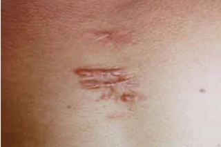 成都祛疤痕效果好的醫(yī)院有哪些？