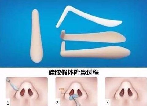 上海哪家醫(yī)院祛斑去痣好？專家?guī)懔私庾钸m合你的祛斑去痣方法！