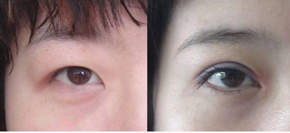 上海市激光修復(fù)痘坑效果如何？哪家醫(yī)院技術(shù)更好？