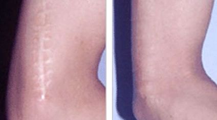 哈爾濱哪家醫(yī)院去除痘痘增生效果好，推薦給大家！