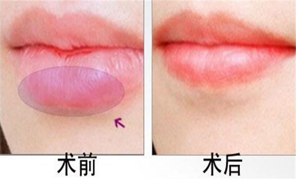 2023臺州超聲刀祛除妊娠紋上榜清單前十名專家(李影影、沈正洲、林子豪從評價(jià)看挺正規(guī))