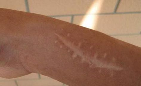 南京哪家醫(yī)院的疤痕修復效果最佳？