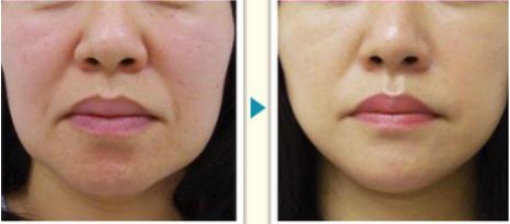 溫州激光祛痘醫(yī)院排行榜，哪家專業(yè)好評多